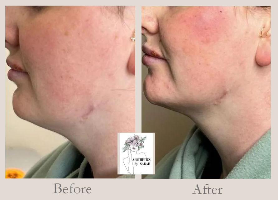 Aesthetics by Sarah - Dermal Filler