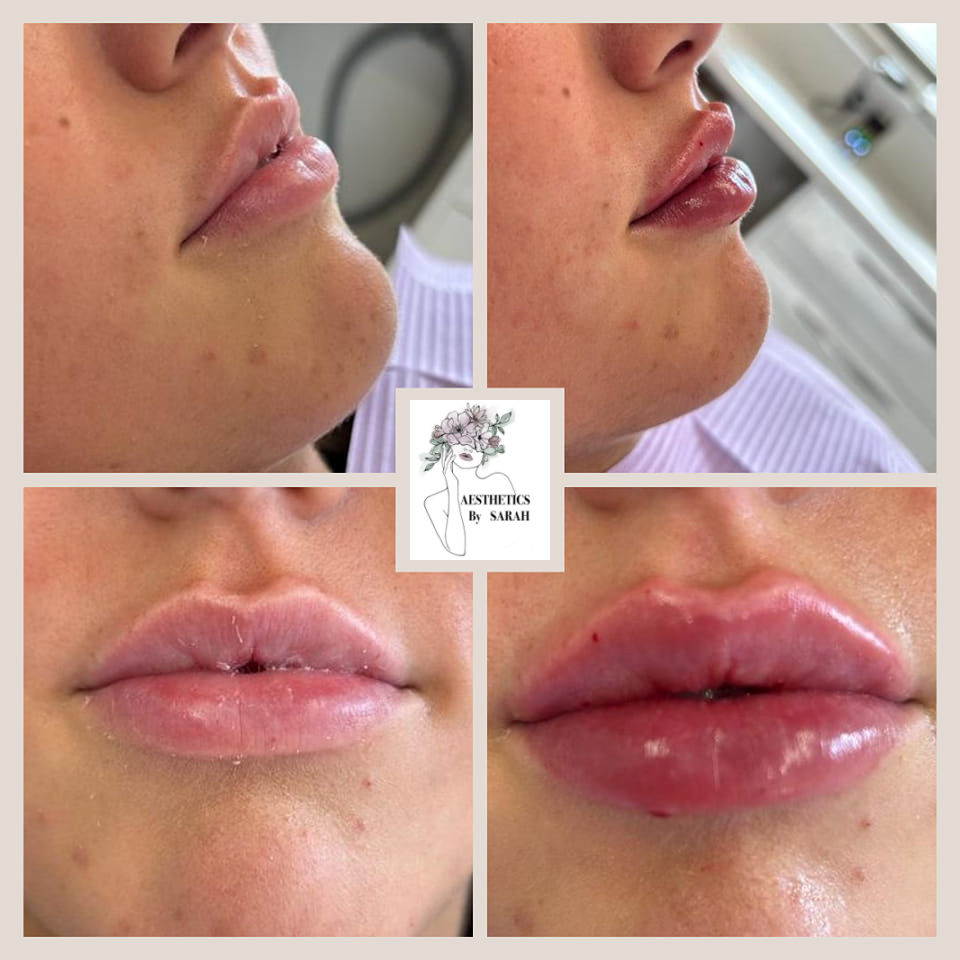 Aesthetics by Sarah - Dermal Filler